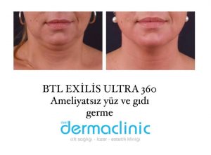 BTL Exilis ultra