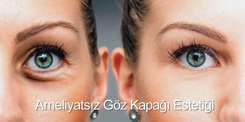 Ameliyatsız Göz Kapağı Estetiği