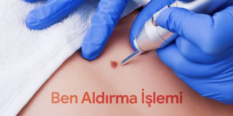 Ben Aldırma İşlemi Nasıl Olur? Ben Aldırma Fiyatları