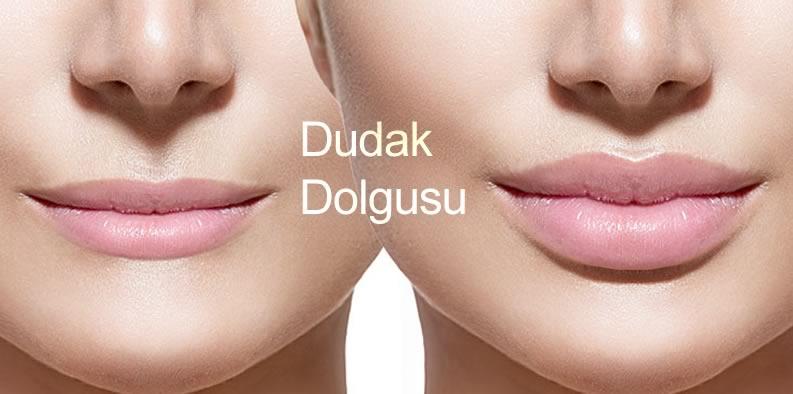 Dudak Dolgusu