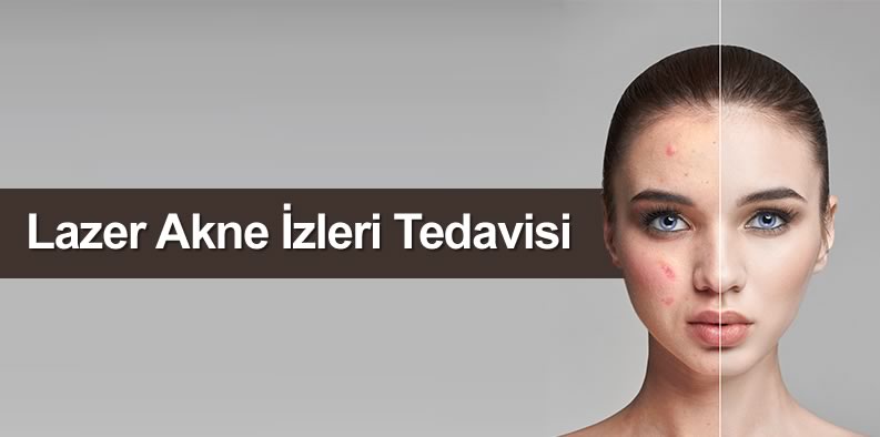 Lazer akne izi tedavisi